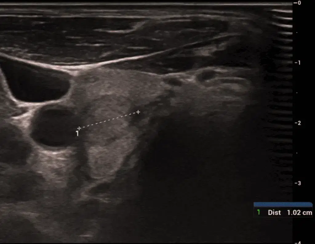 TIRADS TM For Managing Thyroid Nodules on Ultrasound