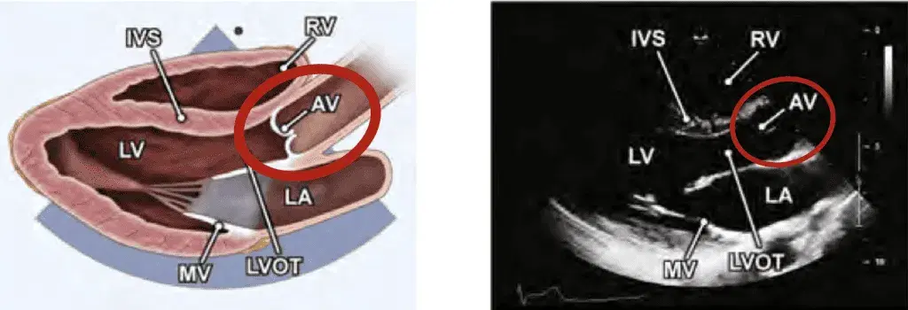 Aortic Stenosis: Modern Techniques in Echocardiography