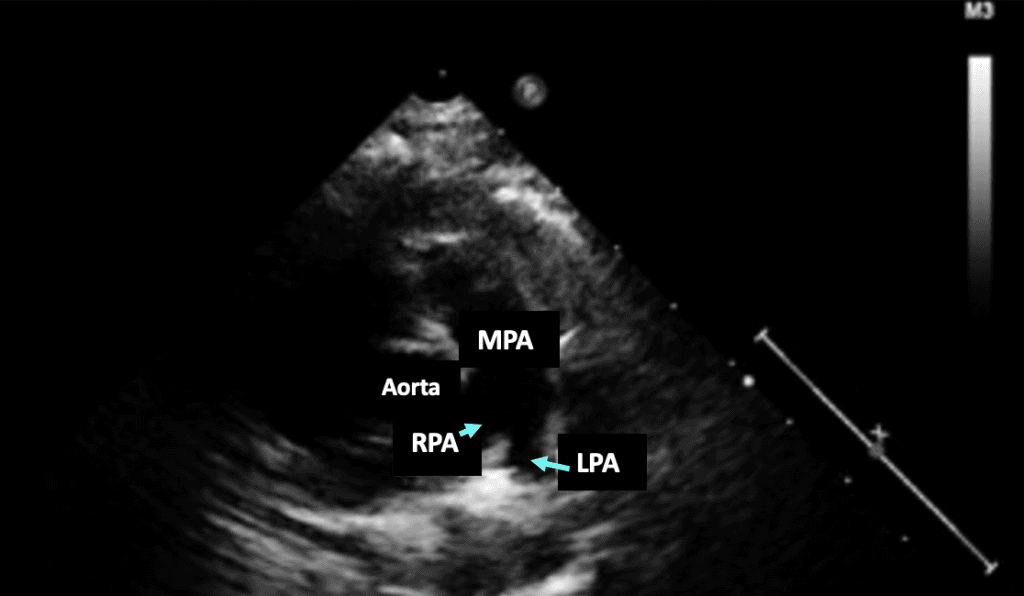 Pulmonary Hypertension