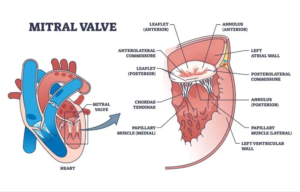 Mitral Regurgitation: An Update