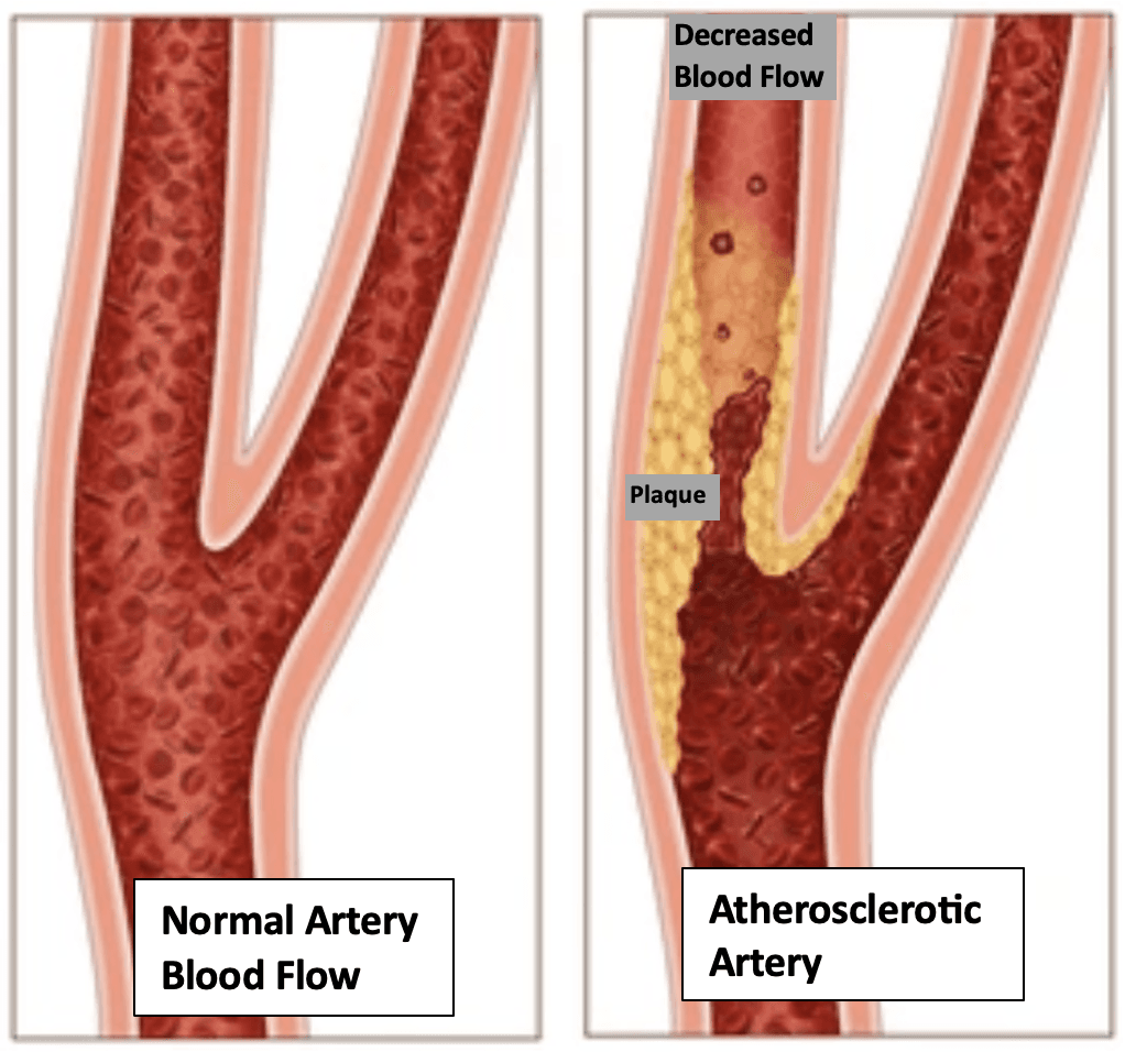 Understanding Cardiovascular Risk and Assessment Using Non-invasive Testing