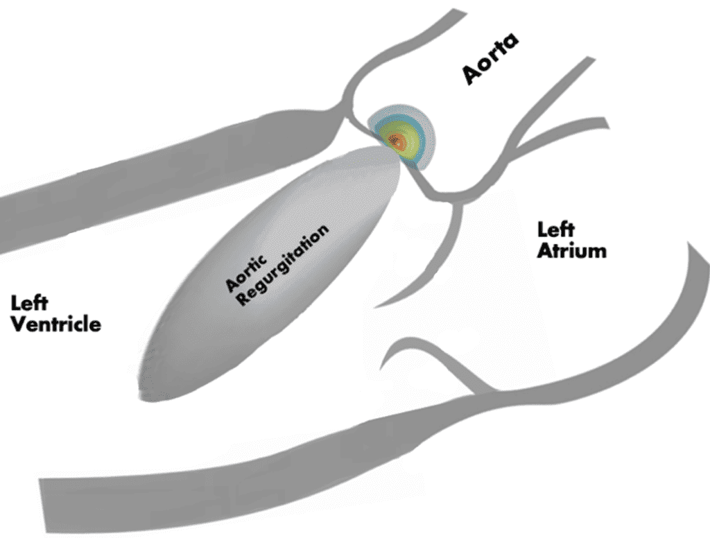 Aortic Regurgitation Part 2: Quantification