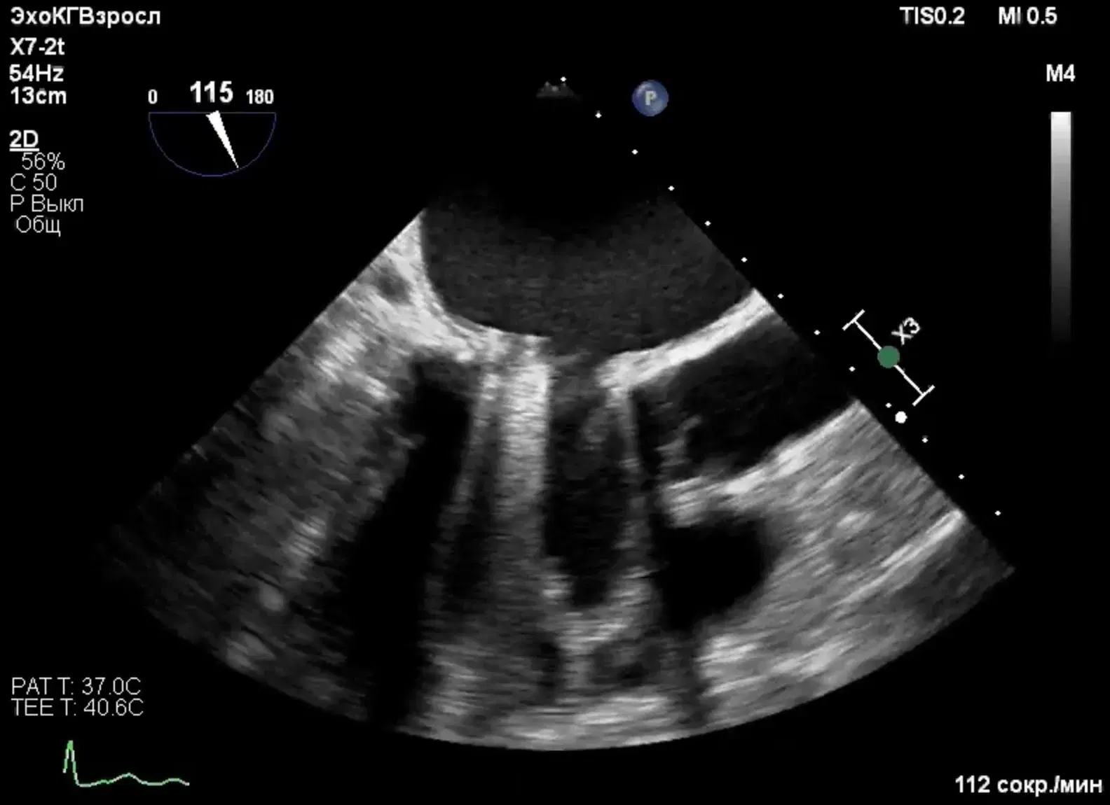 Case Studies in Infective Endocarditis an Update, part 2