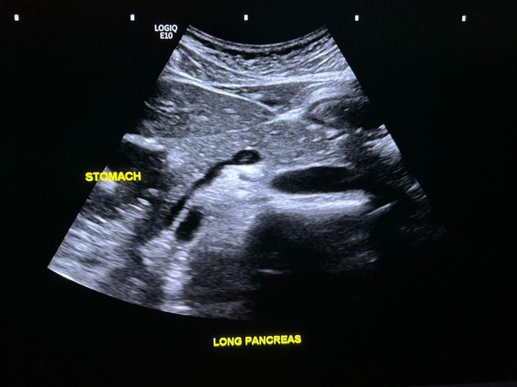 The Pancreas: Fluid and Cysts