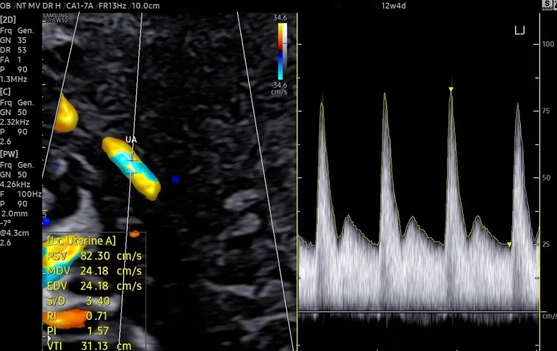Advanced Ultrasound Techniques: Uterine Artery Doppler     First Trimester   Pre-Eclampsia Screening 