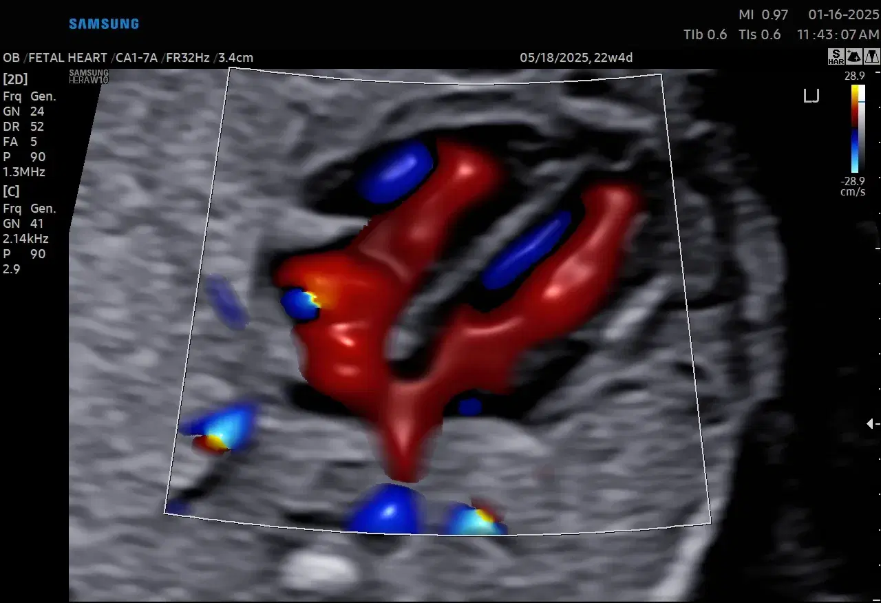 Part 1 Fetal Cardiac Morphology: Understanding the Four Chambers and Normal Markers