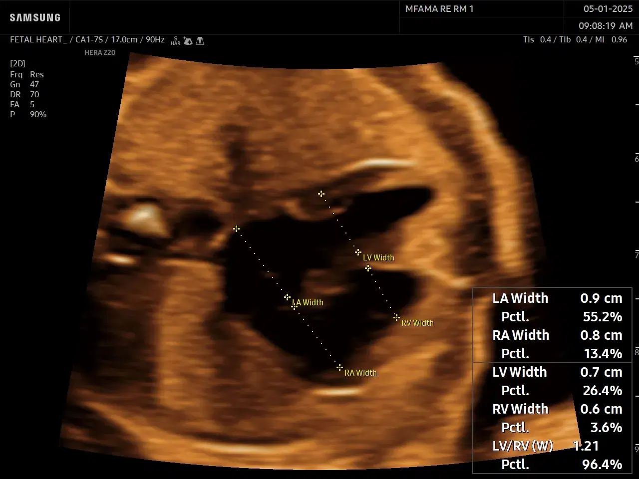 Part II Advanced Diagnostics: Identifying Congenital Heart Defects Using the 4-Chamber View