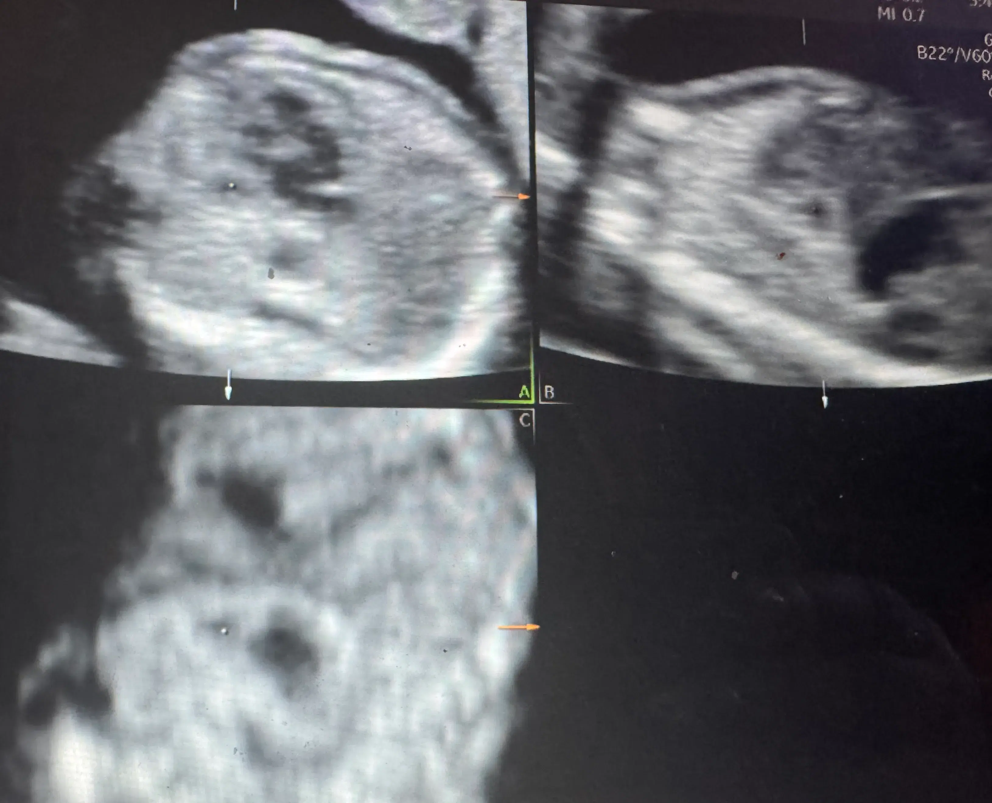 Prenatal Diagnostic Imaging: A Focused Approach to Congenital Pulmonary Airway Malformation