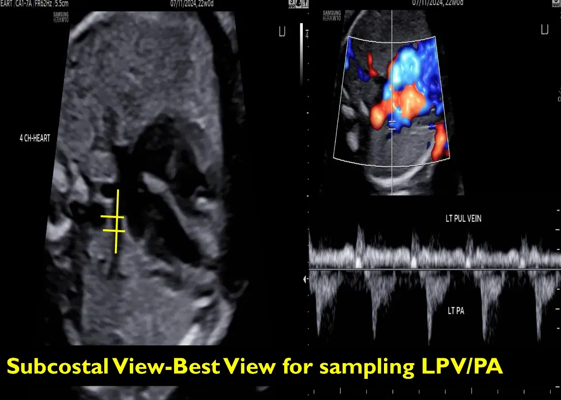 Fetal Echocardiography Screening Essentials: Technique, Protocol, and Workflow