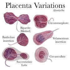 Placental Variants That Matter: Succenturiate Lobe, Circumvallate, and Placental Lakes