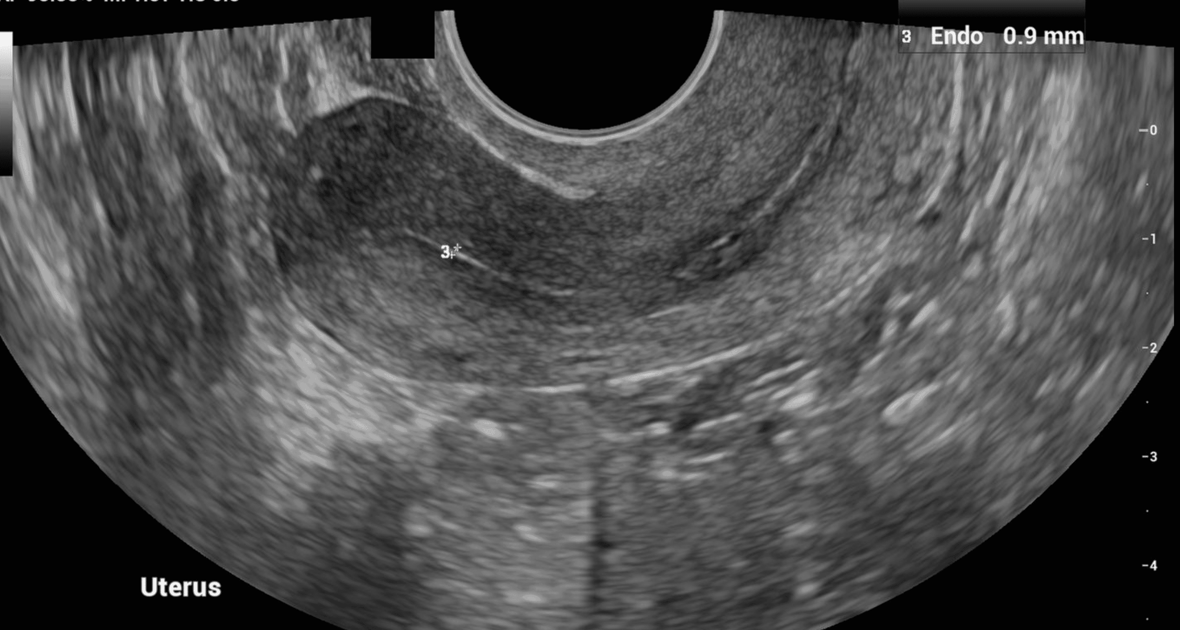 The Endometrium