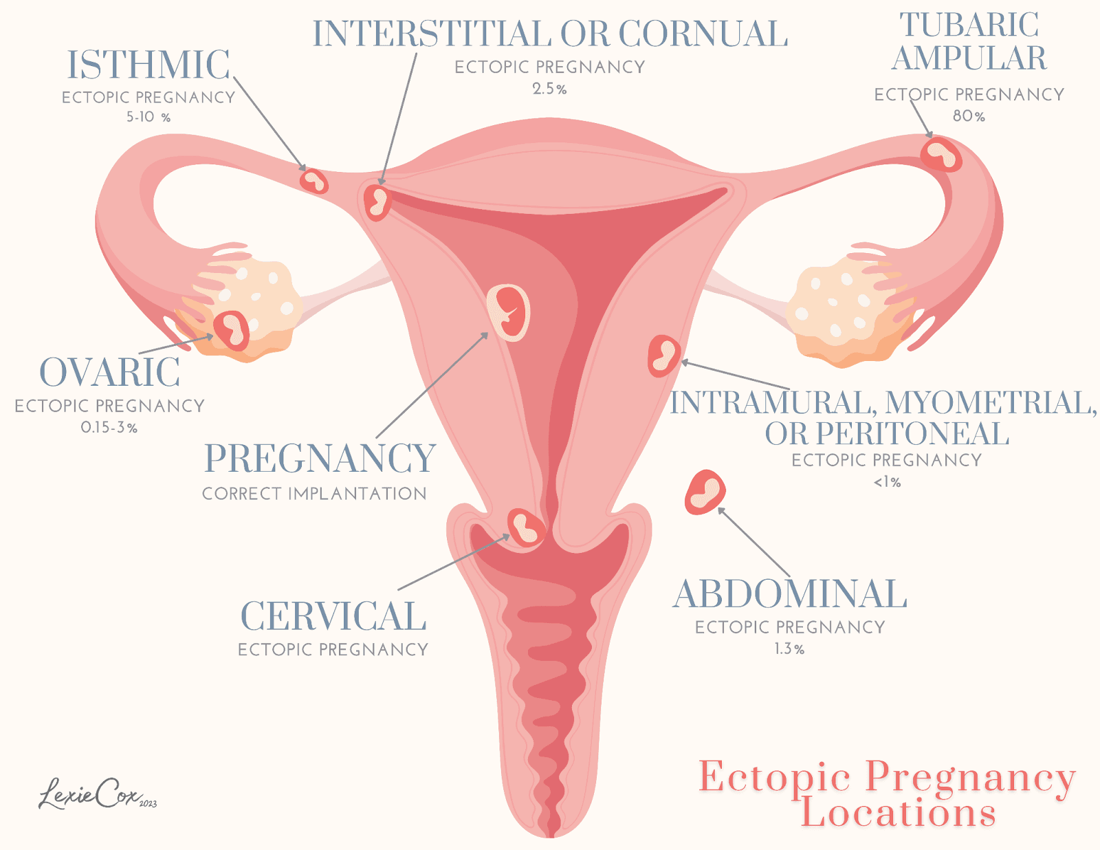 Ectopic Pregnancy