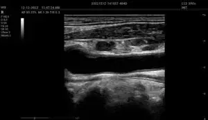 Carotid Intima-Media Thickness: CIMT Imaging