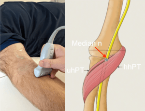 The Median Nerve