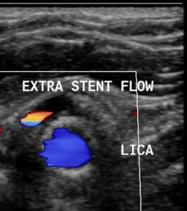 Duplex Ultrasound of Carotid Stents