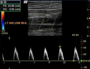 Evaluation of Lower Extremity Bypass Grafts