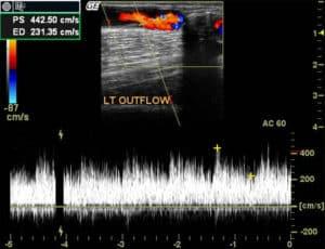 Peripheral Arterial Studies: Non-Atherosclerotic Pathologies