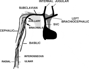 Upper Extremity Venous Evaluation