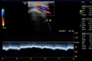 Case Series in Lower Extremity Venous Doppler, Part I