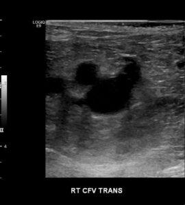 Duplex Diagnosis of Lower Extremity Venous Thrombosis