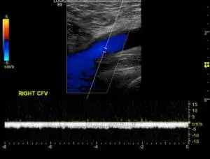 Case Series in Lower Extremity Venous Doppler, Part II