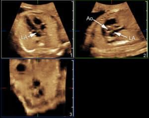 Volumetric Imaging of the Fetal Heart