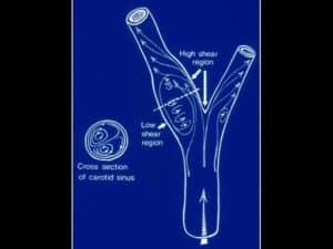 Evolution of the Treatment of Carotid Atherosclerosis: An Update