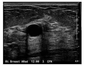 Sonographic Evaluation of Benign and Malignant Breast Masses