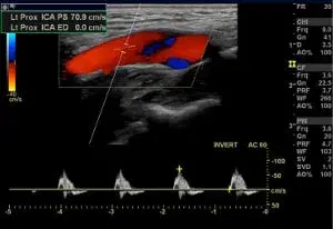 Case Studies in Cerebrovascular Duplex Imaging, Series 2