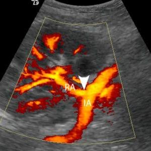 Ultrasound Evaluation of the Renal Transplant