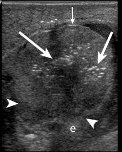 Ultrasound Evaluation of Acute Scrotal Pain