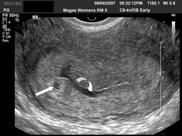 Transvaginal Evaluation Of The 1st Trimester: Normal And Abnormal