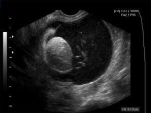 Sonography of the Ovary: Benign vs. Malignant