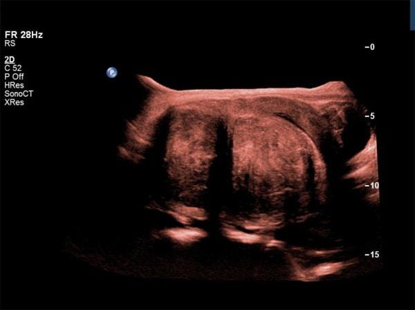 Sonographic Evaluation of Uterine Leiomyomas and Adenomyosis