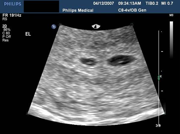 The Sonographic Evaluation Of Twin-To-Twin Transfusion Syndrome