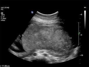 Sonographic Evaluation of the Normal and Abnormal Placenta