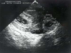 Sonographic Evaluation of Ectopic Pregnancies