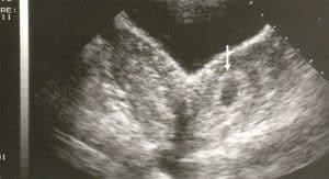 The Sonographic Detection Of Uterine Anomalies