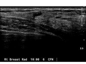 Screening Breast Ultrasound