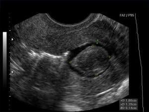 Saline Infusion Sonohysterography