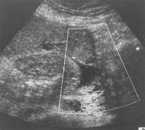 Oligohydramnios: Sonographic Assessment & Clinical Implications