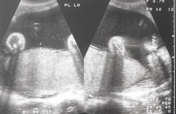 Middle Cerebral Artery Doppler Peak Systolic Velocity in the Evaluation of Fetal Anemia