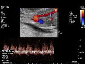 First Trimester Screening For Chromosomal And Structural Malformations