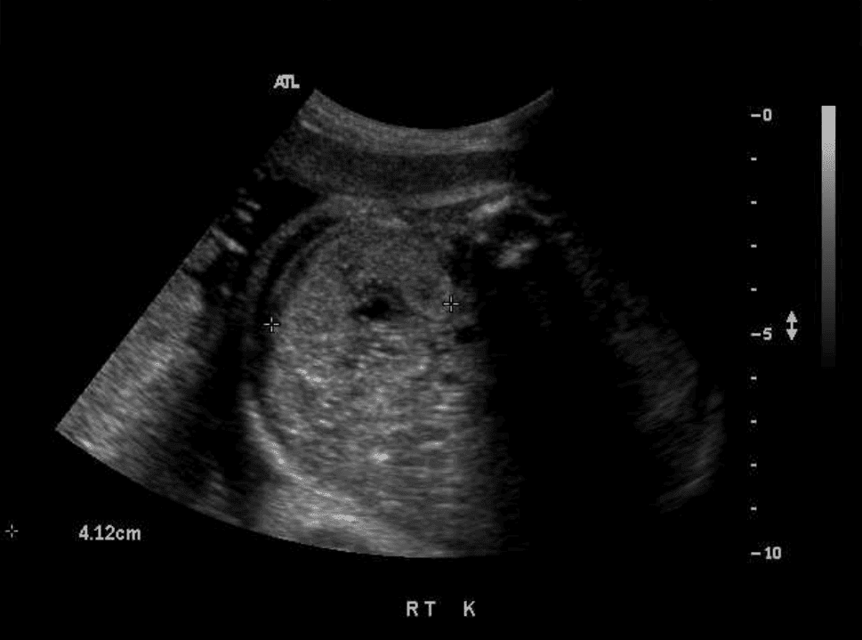 Echogenic Fetal Kidneys: Differential Diagnosis and Postnatal Outcome