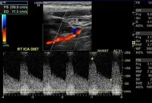 Carotid Duplex Examination