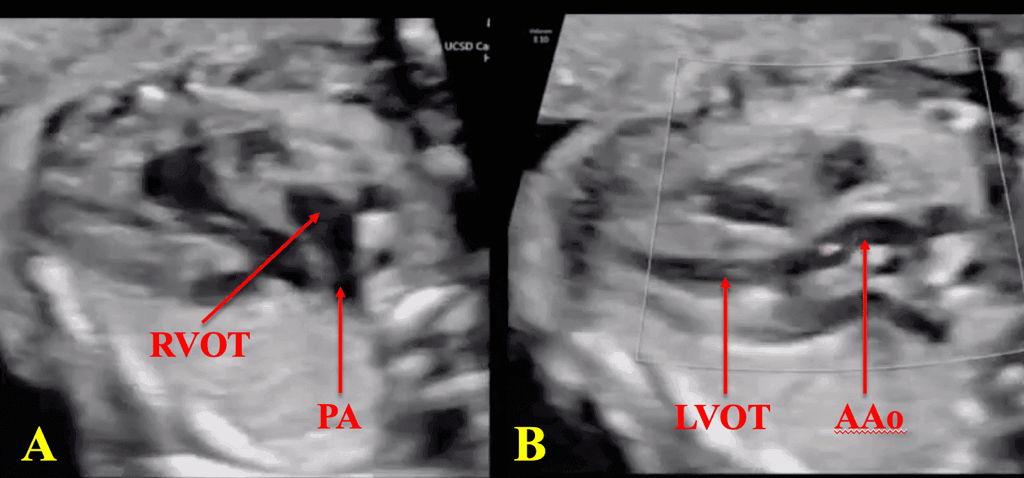 Fetal Cardiac Outflow Tracts: Normal and Abnormal Anatomy