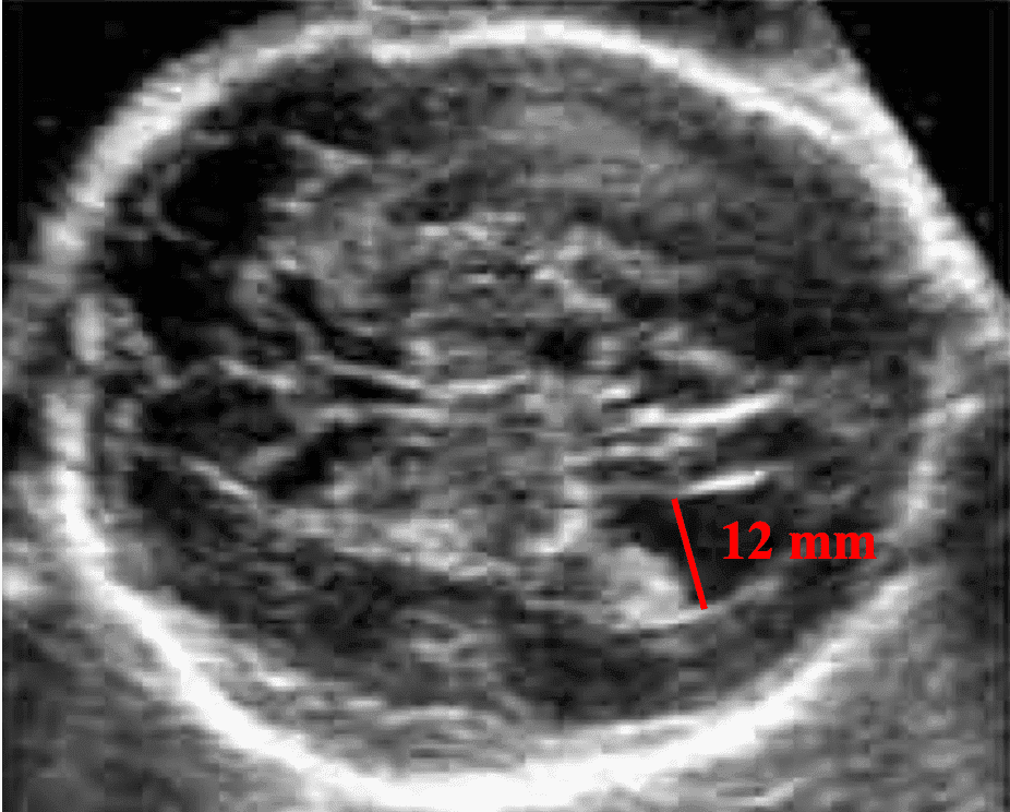 Fetal Intracranial Anomalies