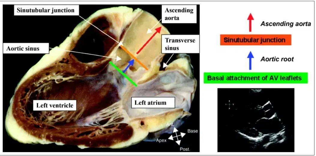 Aortic Stenosis