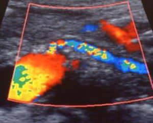 Duplex Ultrasound Assessment of the Mesenteric Circulation