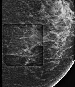 Stereotactic and Tomosynthesis Guided Breast Biopsy